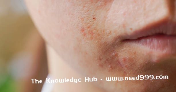 acne problem on face close up of asian woman with acne problem on her face A woman with acne on her mouth stock pictures, royalty-free photos & images