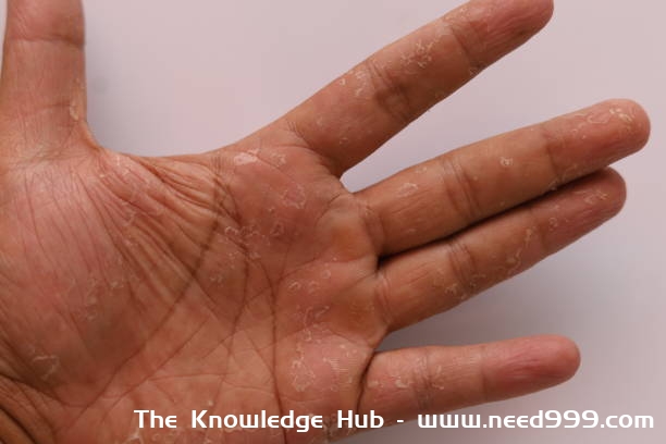 How to prevent hand peeling?