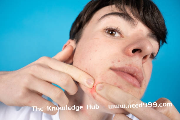 Teenager popping pimple Closeup of teenager exploding a pimple. Dermatology and acne problems in adolescence concept. Acne on the chin can be caused by a variety of factors stock pictures, royalty-free photos & images